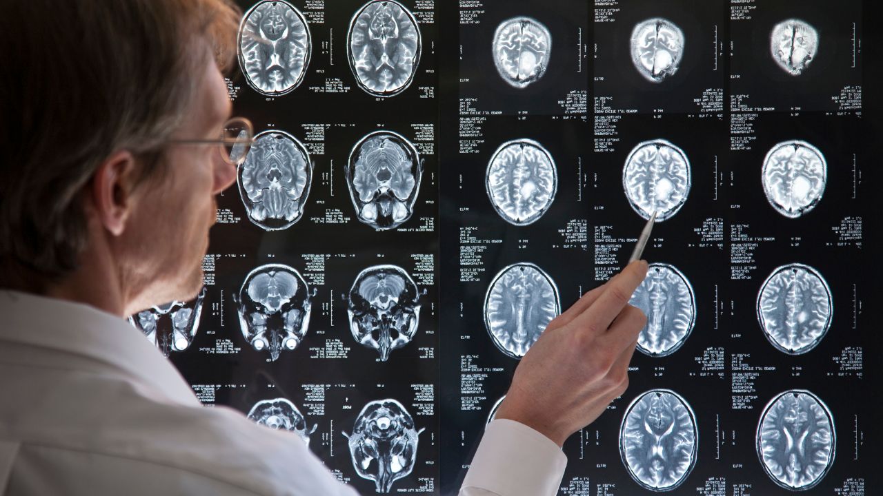 Traumatic Brain Injury Rehabilitation Therapy in Naples