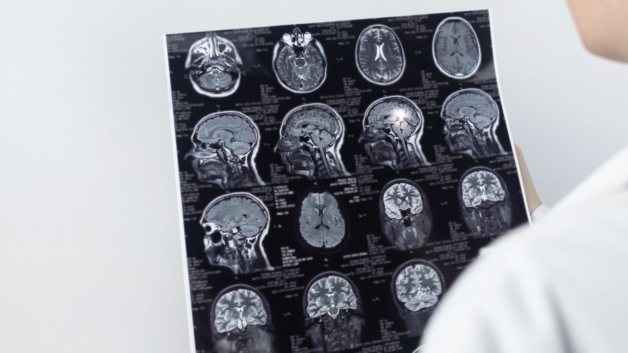 TBI / Concussion Therapy in Marco Island
